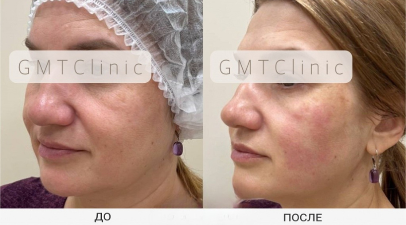 Результат до и после 1