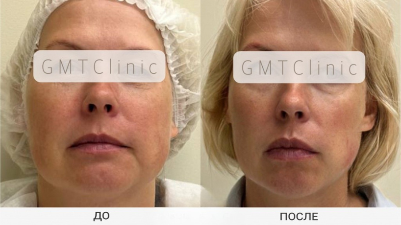 Результат до и после 2