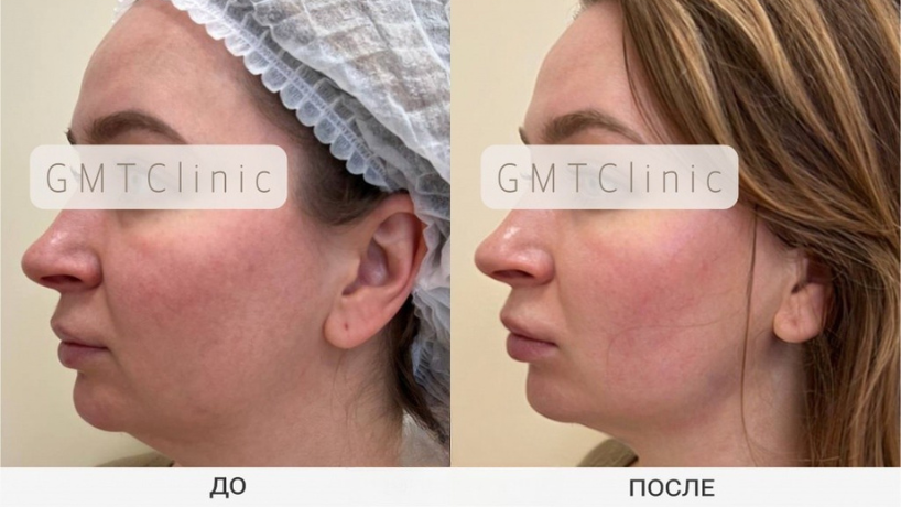 Результат до и после 3