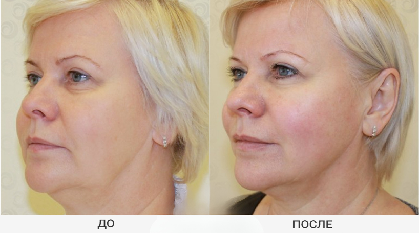 Результат до и после 4