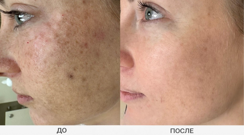 Результат до и после 5