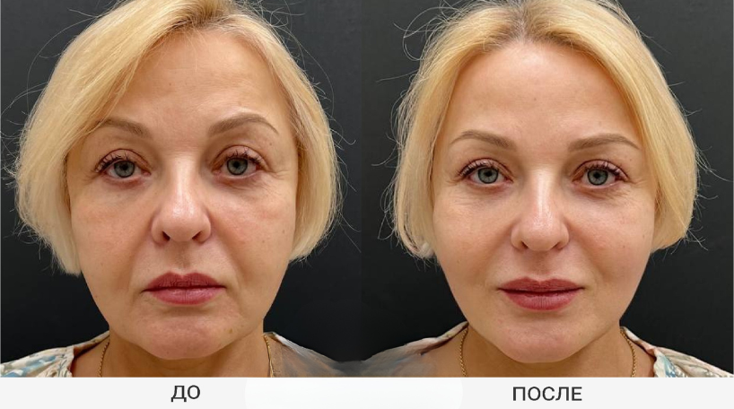 Результат до и после 6