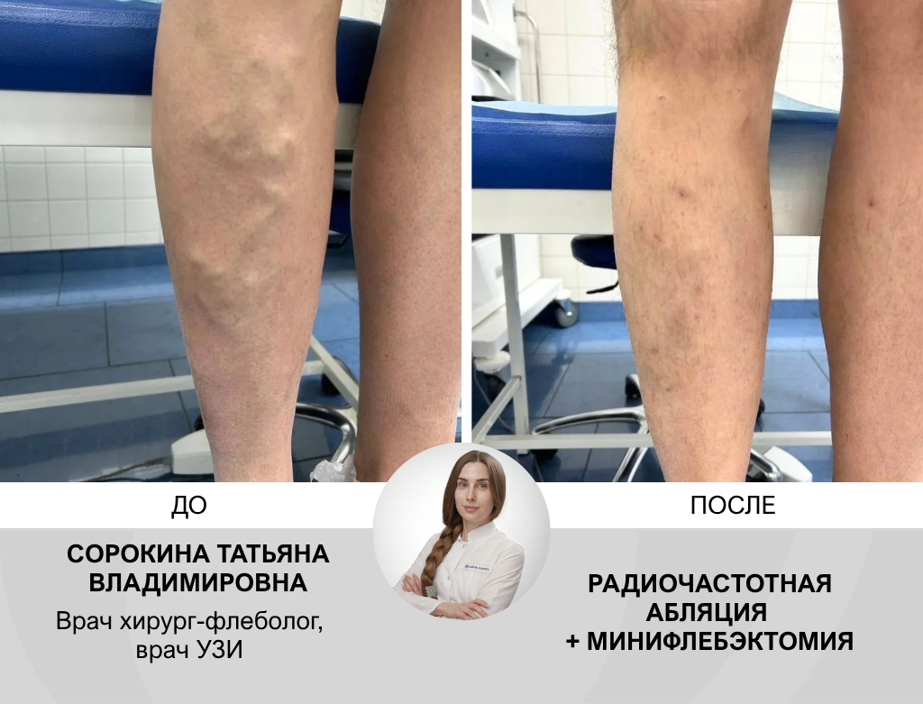 услуги Малоинвазивная радиочастотная облитерация вен - фото №2