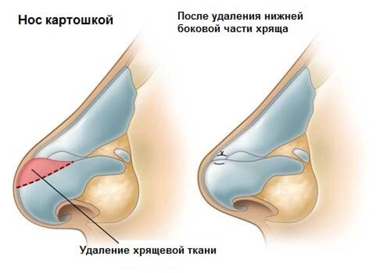 Нос картошкой: причины, коррекция, гармония 