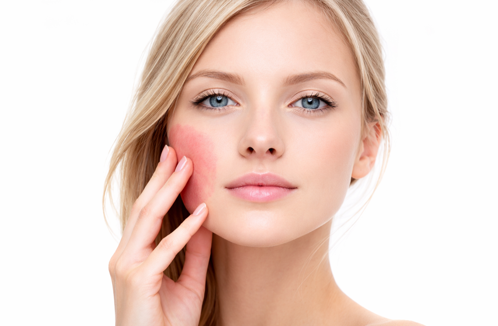 Удаление винных пятен (ангиом, гемангиом)