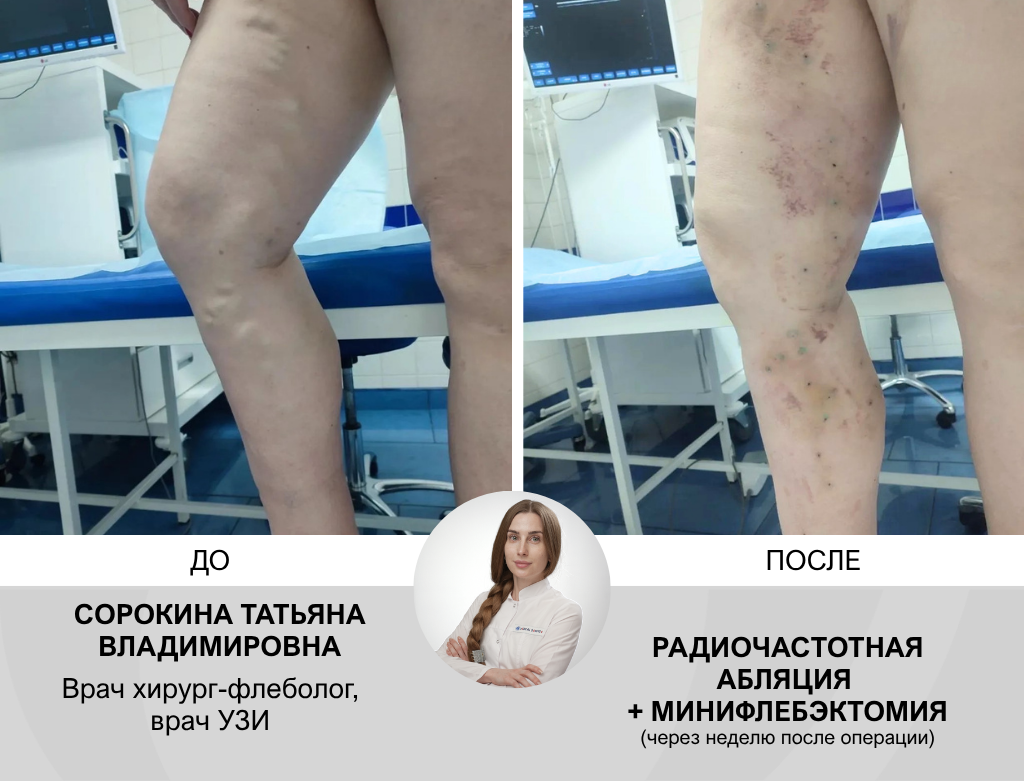 услуги Малоинвазивная радиочастотная облитерация вен - фото №1