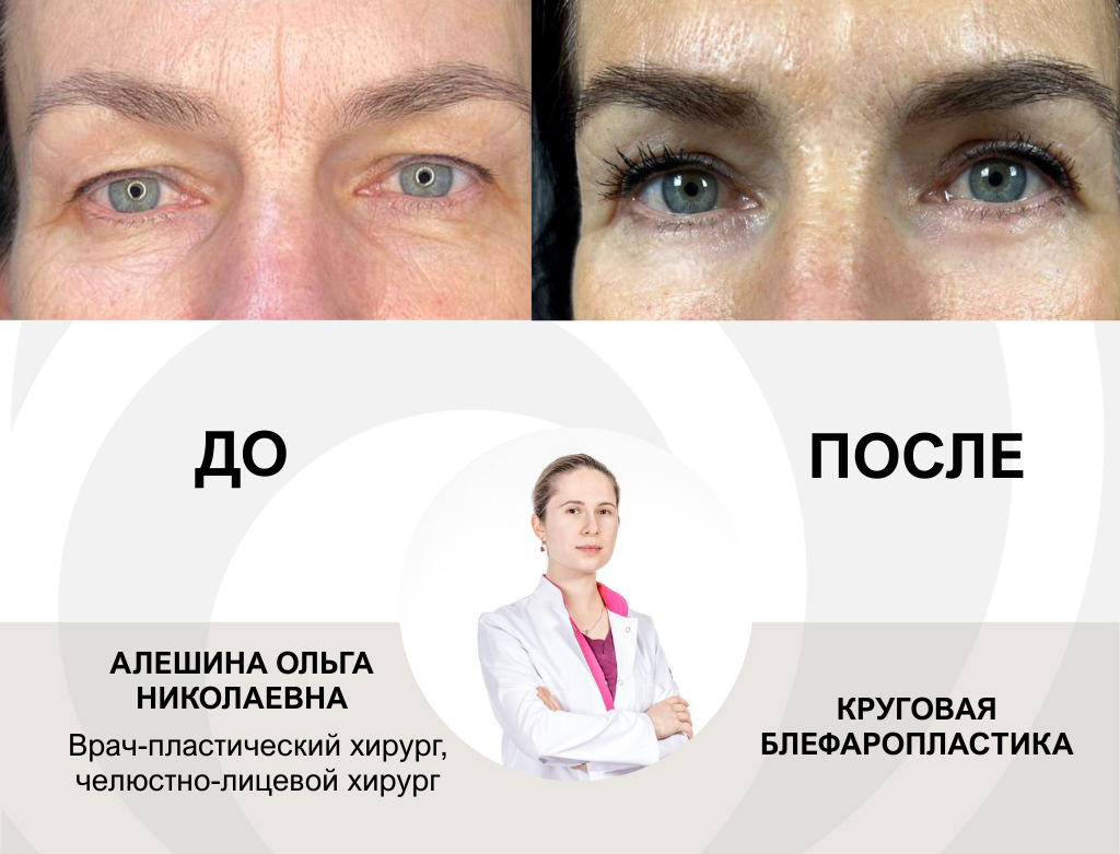 услуги Блефаропластика - фото №4
