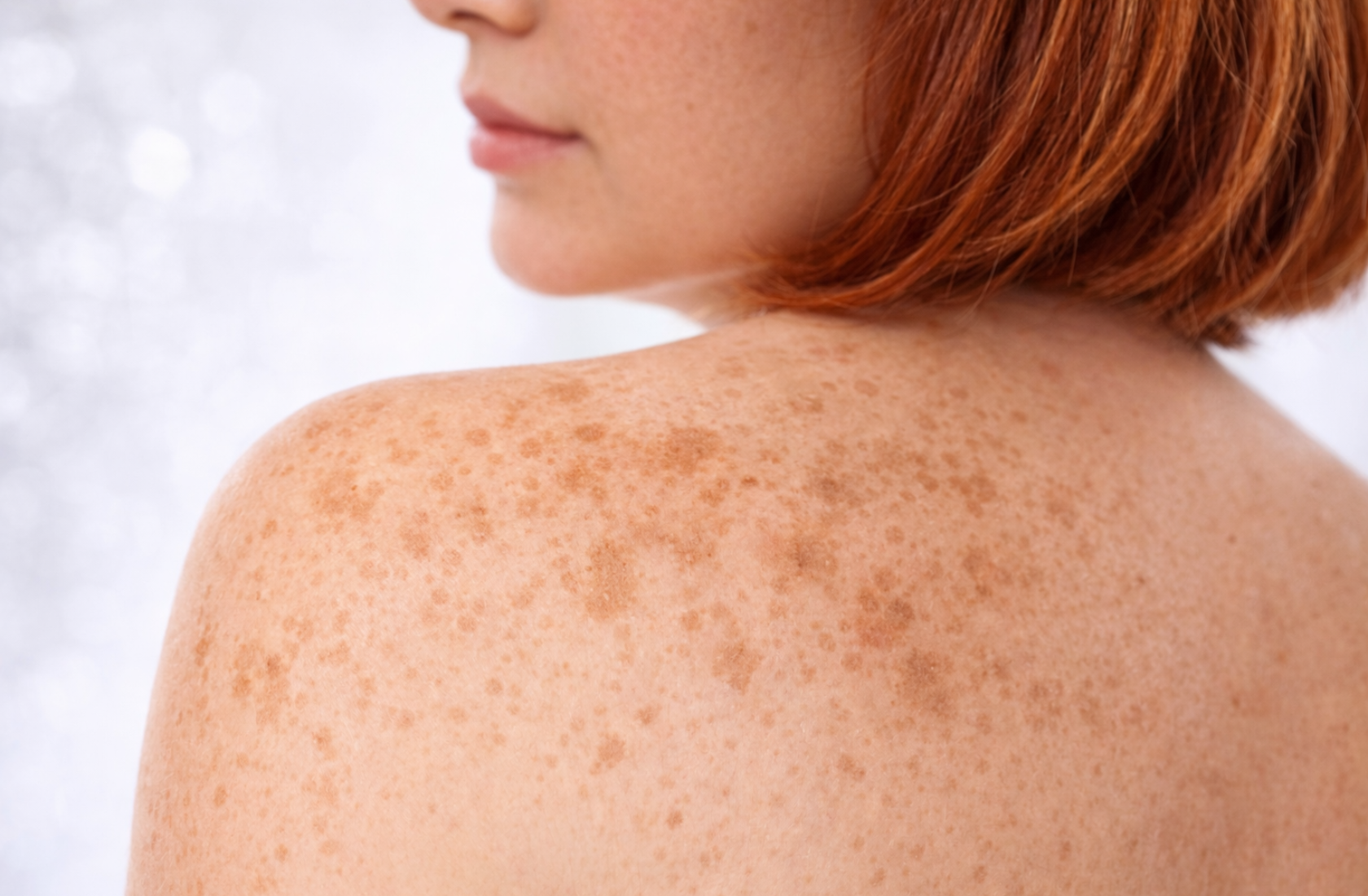 Лечение пигментных пятен на теле