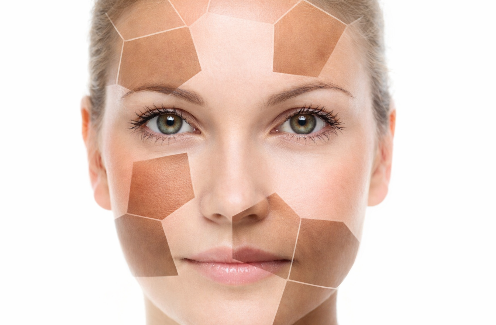 Лечение пигментных пятен на лице