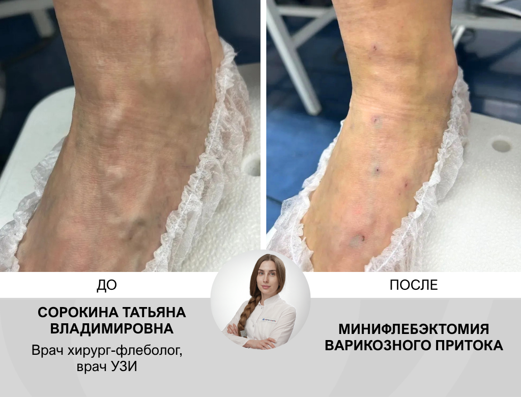 услуги Малоинвазивная радиочастотная облитерация вен - фото №2