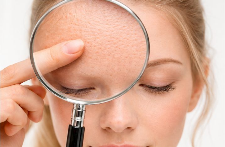 Лечение расширенных пор лазером