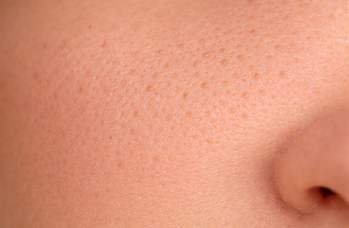 Пилинг от расширенных пор