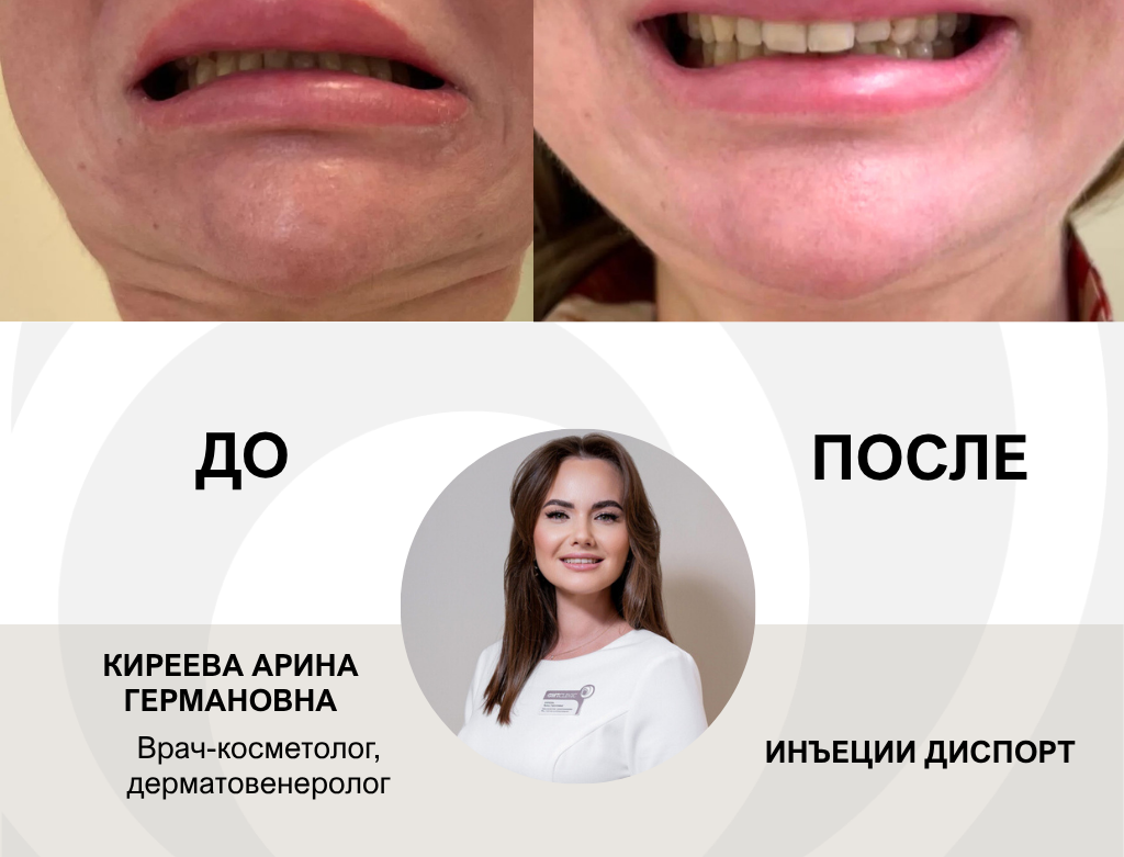 услуги Ботулинотерапия - фото №22