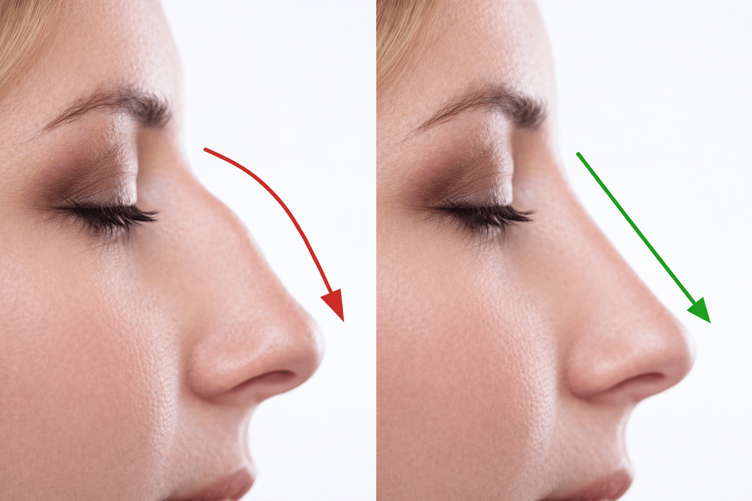 Восстановление носа после ринопластики: ограничения, сроки и уход 