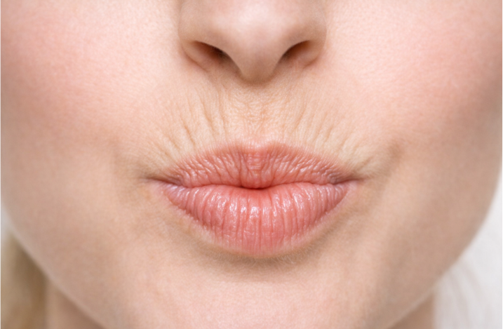 Способы устранения морщин над губой