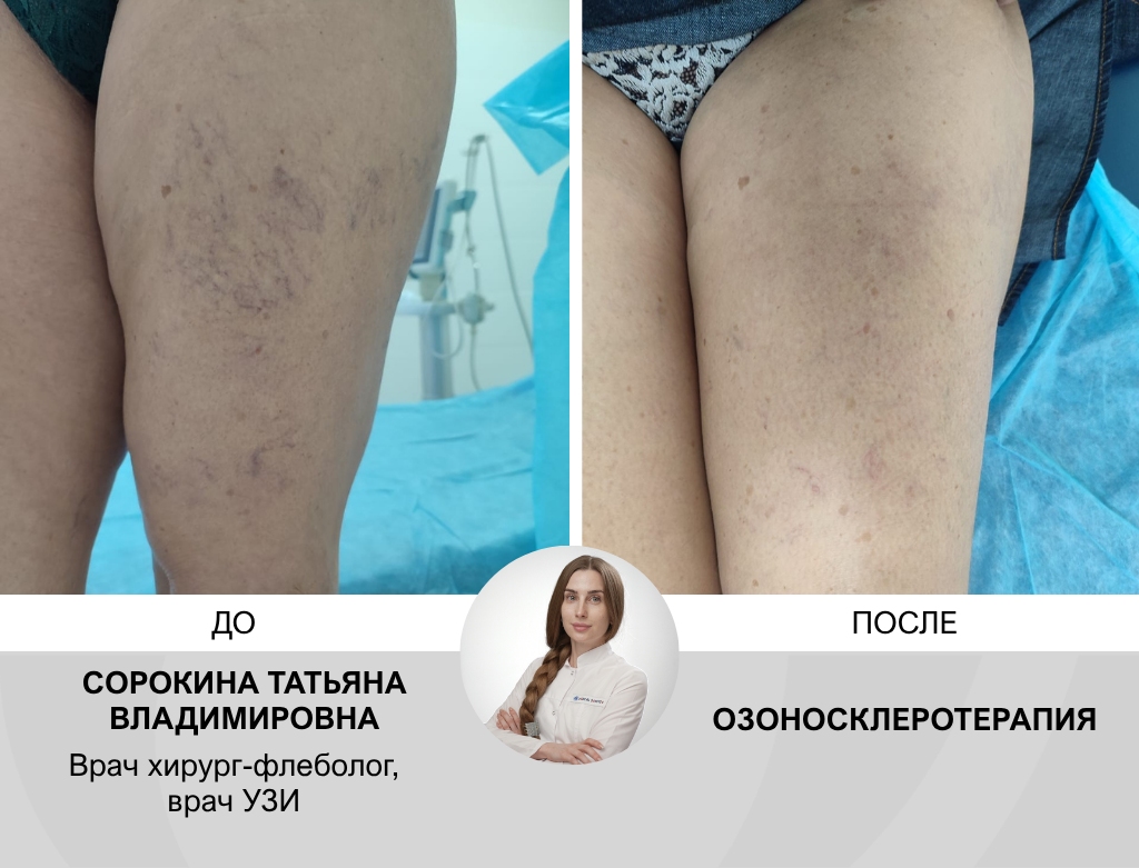 услуги Склеротерапия вен - фото №3