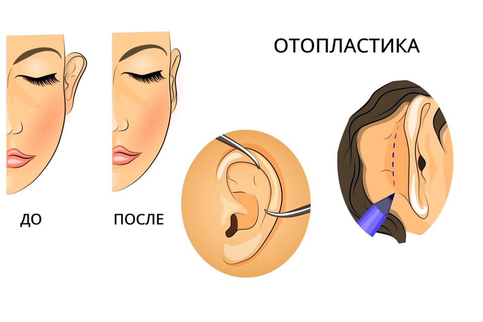 Современные методы отопластики