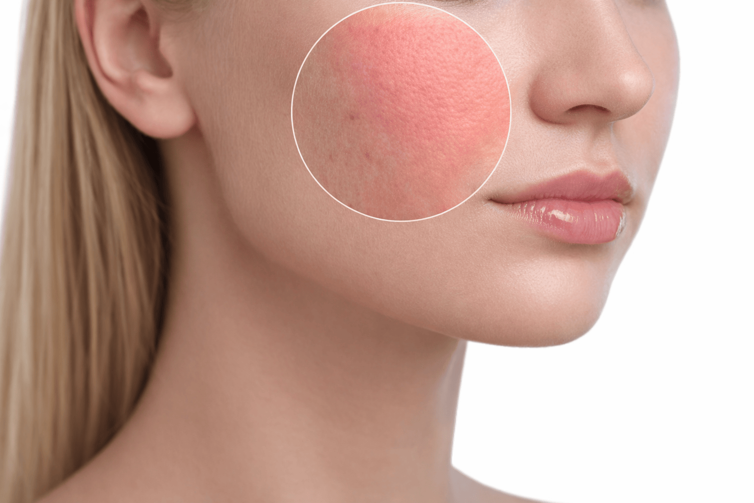 Покраснение кожи – причины и современные методы лечения