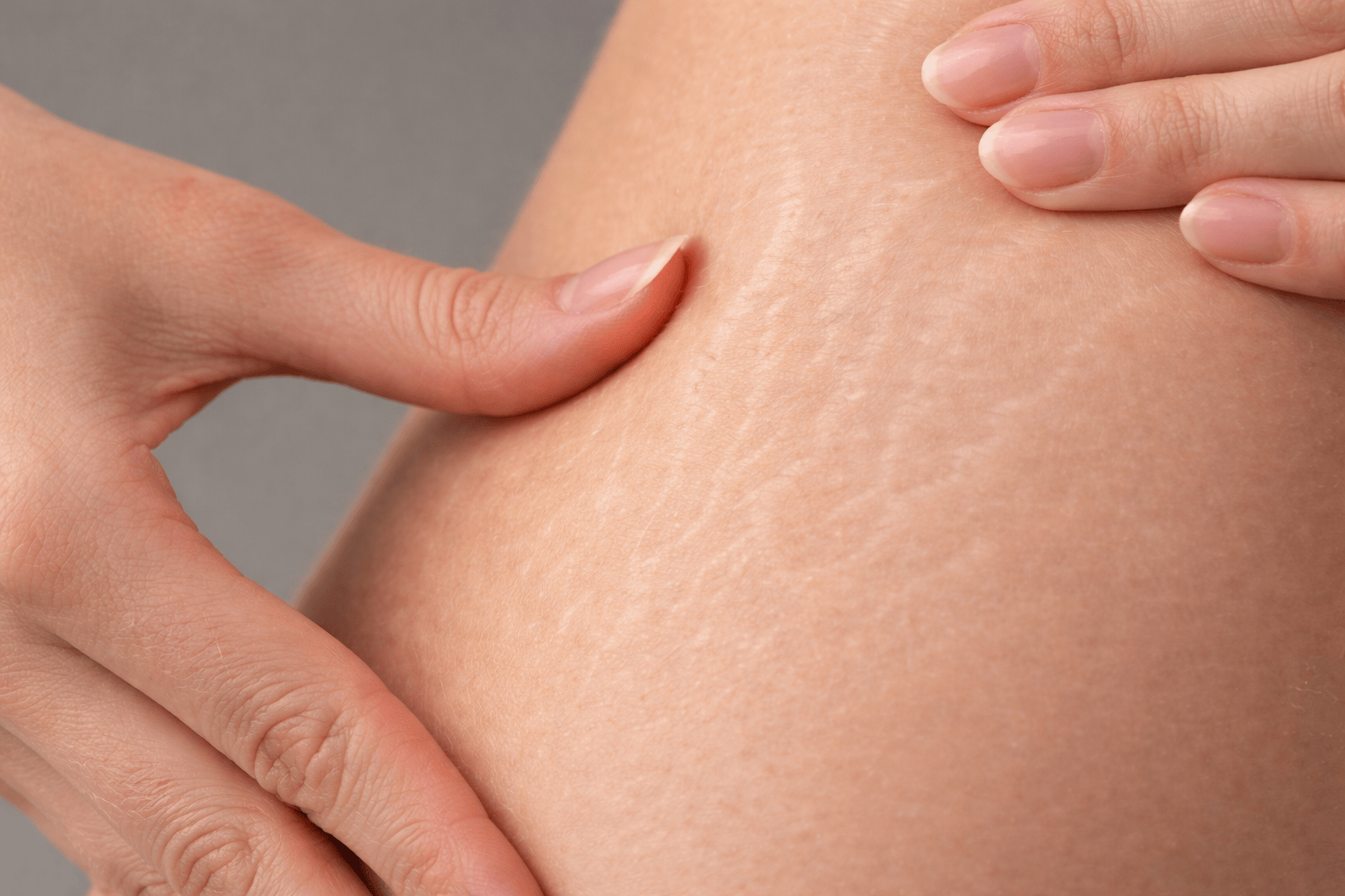 Растяжки на теле: причины, классификация и современные методы коррекции