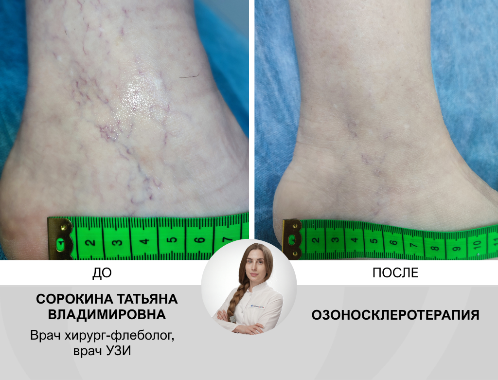 услуги Склеротерапия вен - фото №2