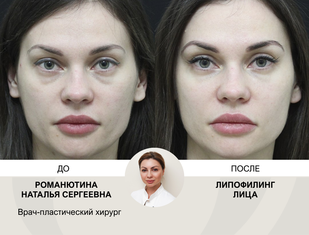 услуги Липофилинг - фото №1