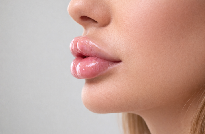 Гиперкоррекция губ: чем она опасна.