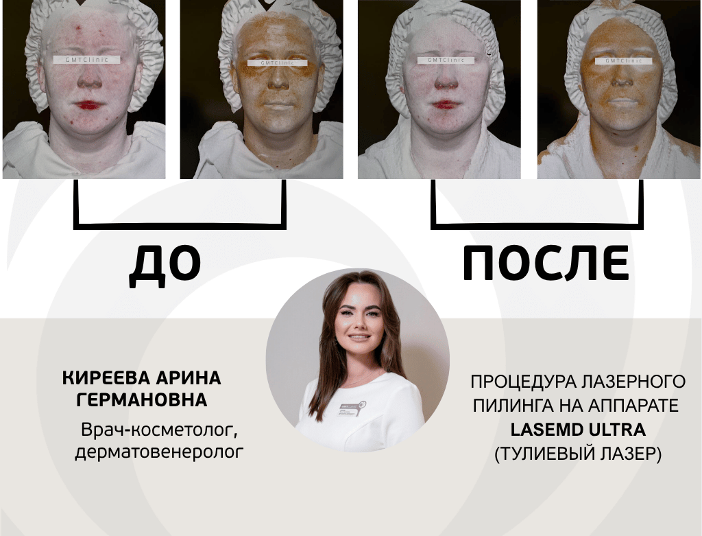 услуги Омоложение lasemd ultra / Ультра - фото №2