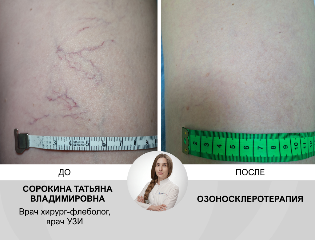 услуги Склеротерапия вен - фото №1