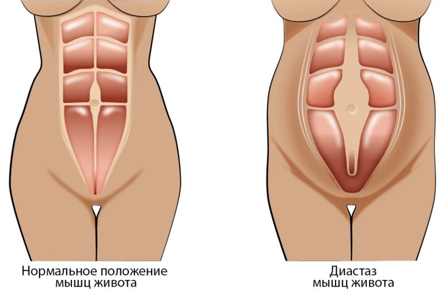 Живот после родов: причины, последствия и способы восстановления