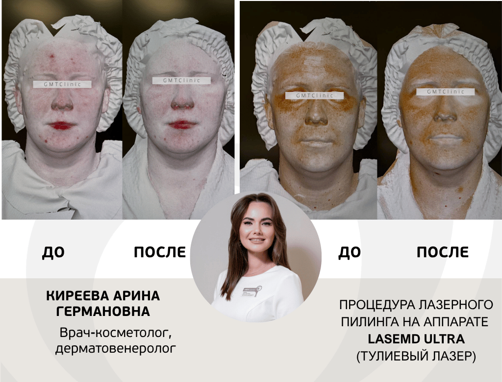 услуги Омоложение lasemd ultra / Ультра - фото №1