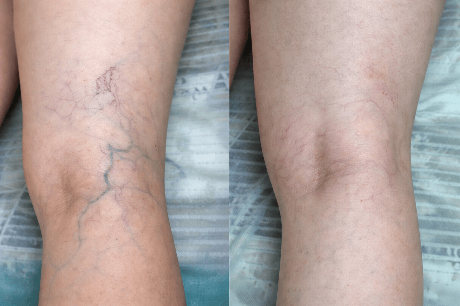 Современные методы лечения варикоза вен у флеболога