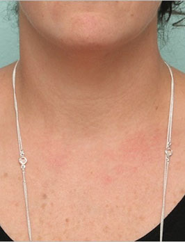 Лазерные шлифовки Contour TRL Sciton
